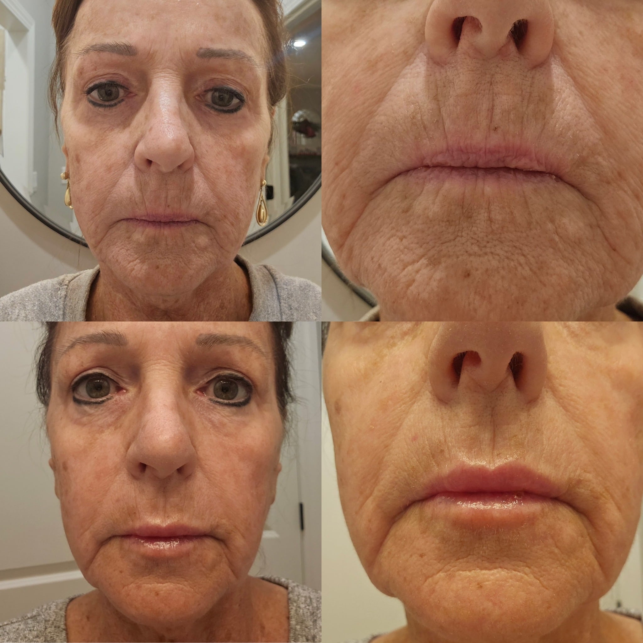 Before and After Image: Lip Filler - front