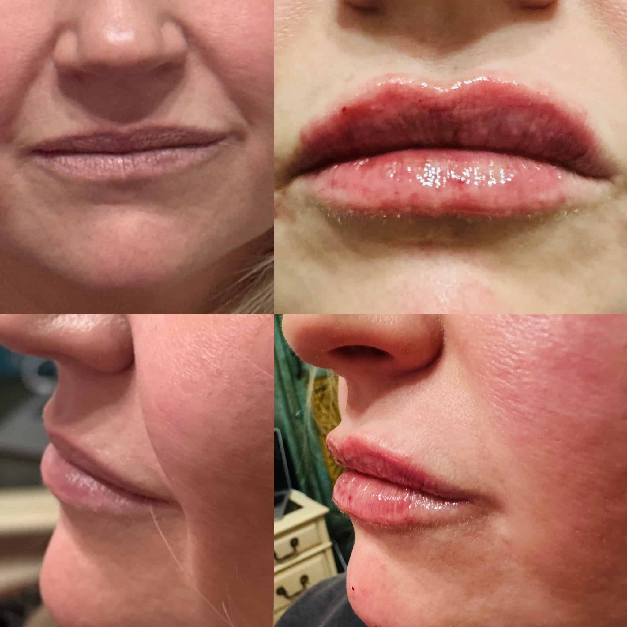 Before and After Image: Lip Filler - front