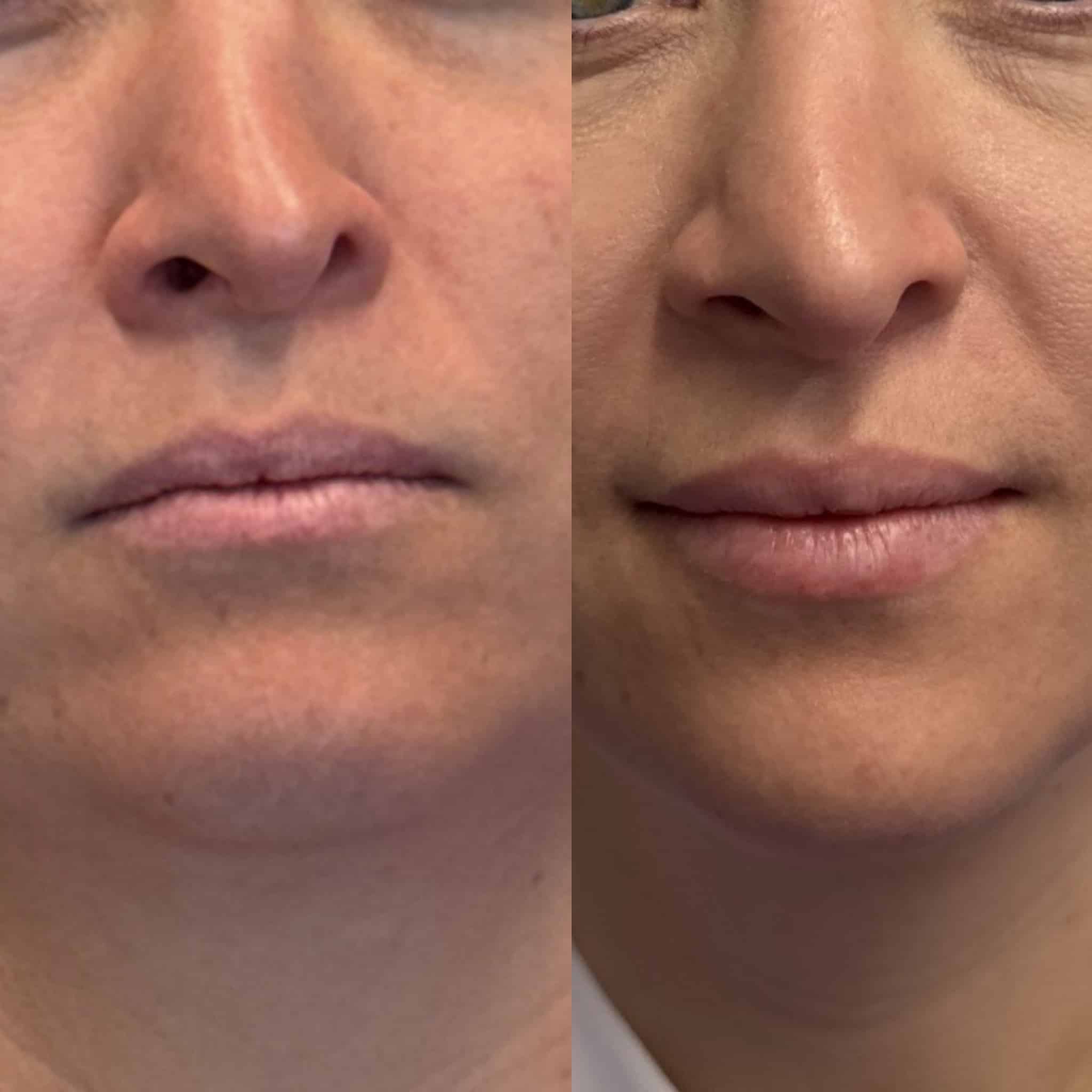 Before and After Image: Lip Filler - front