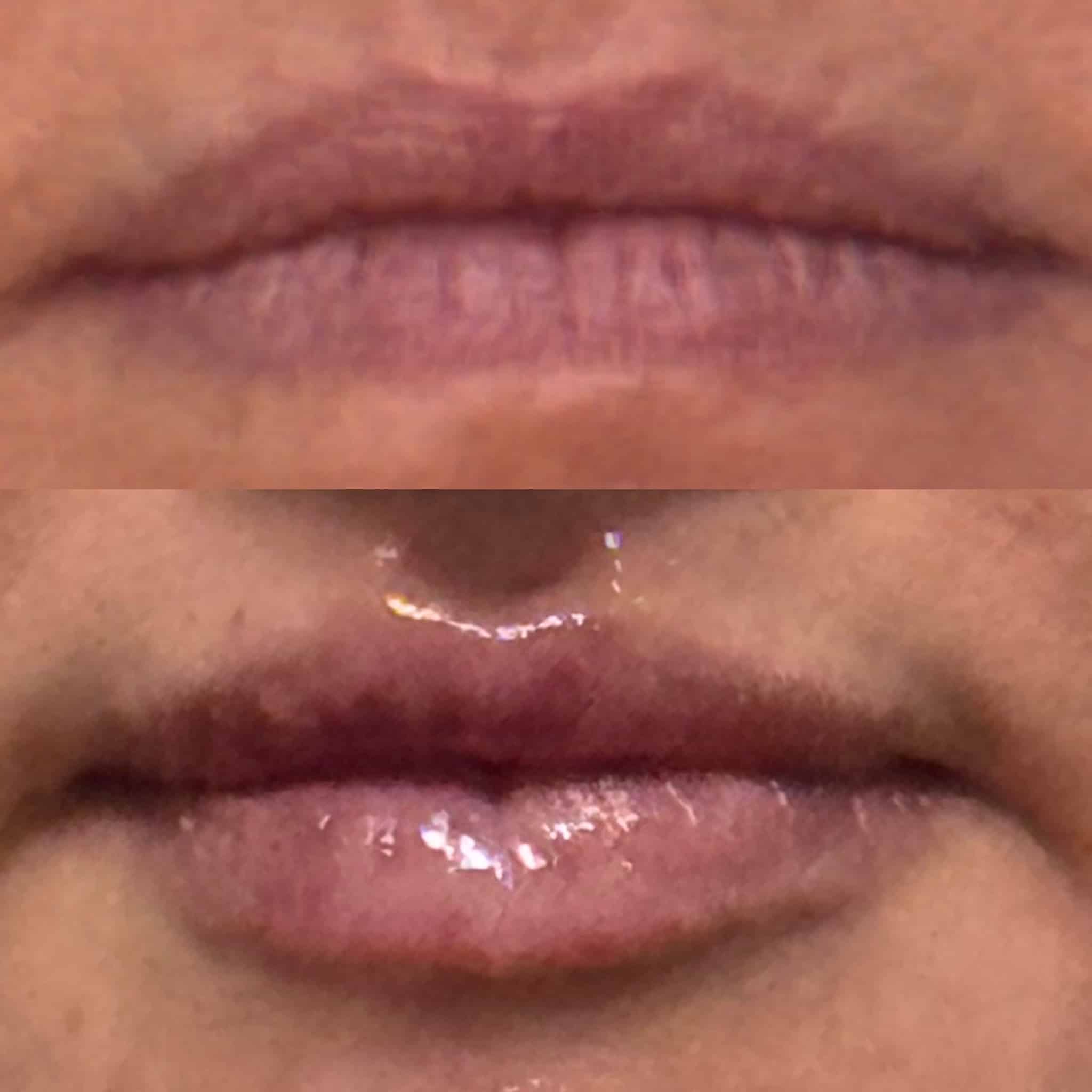 Before and After Image: Lip Filler - front