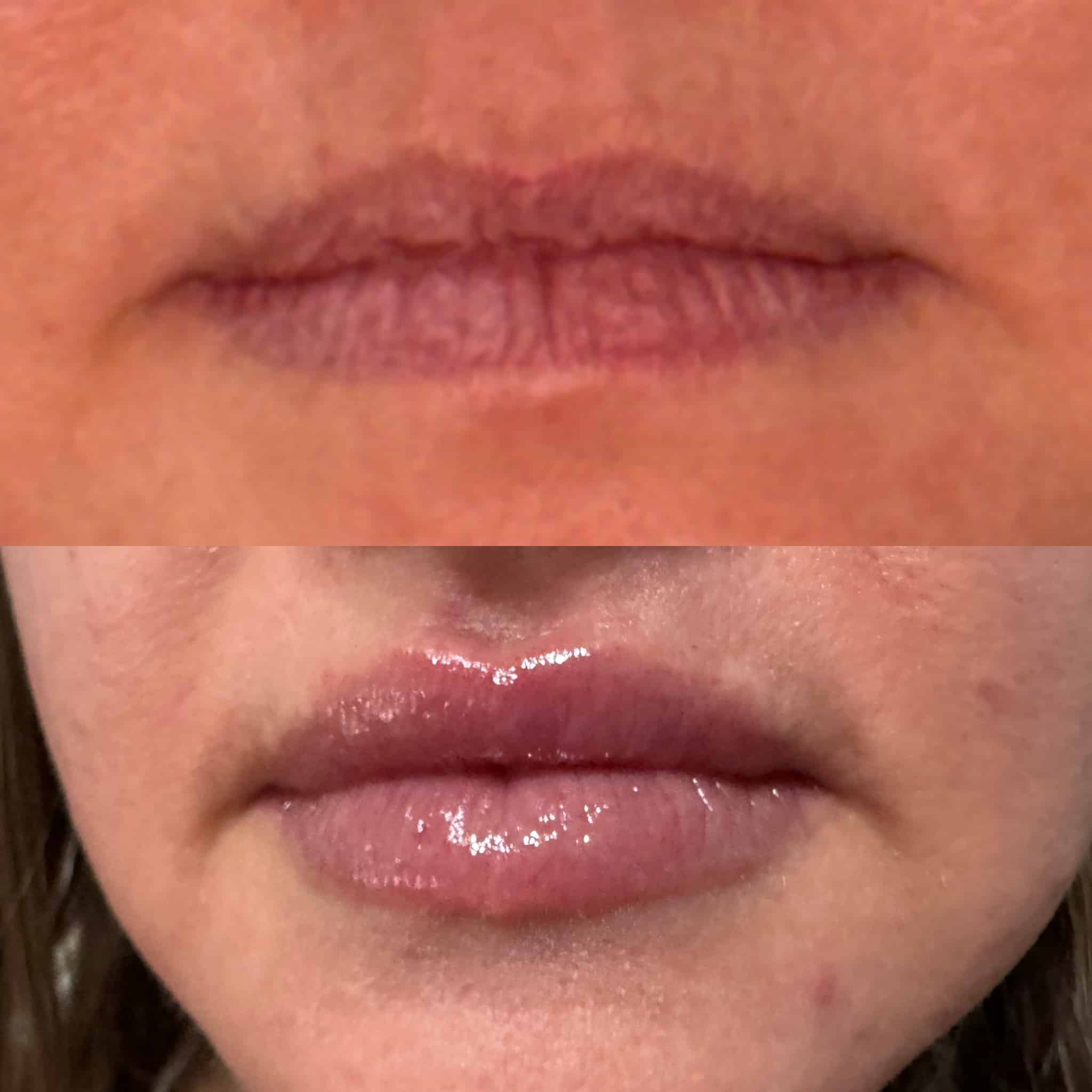 Before and After Image: Lip Filler - front