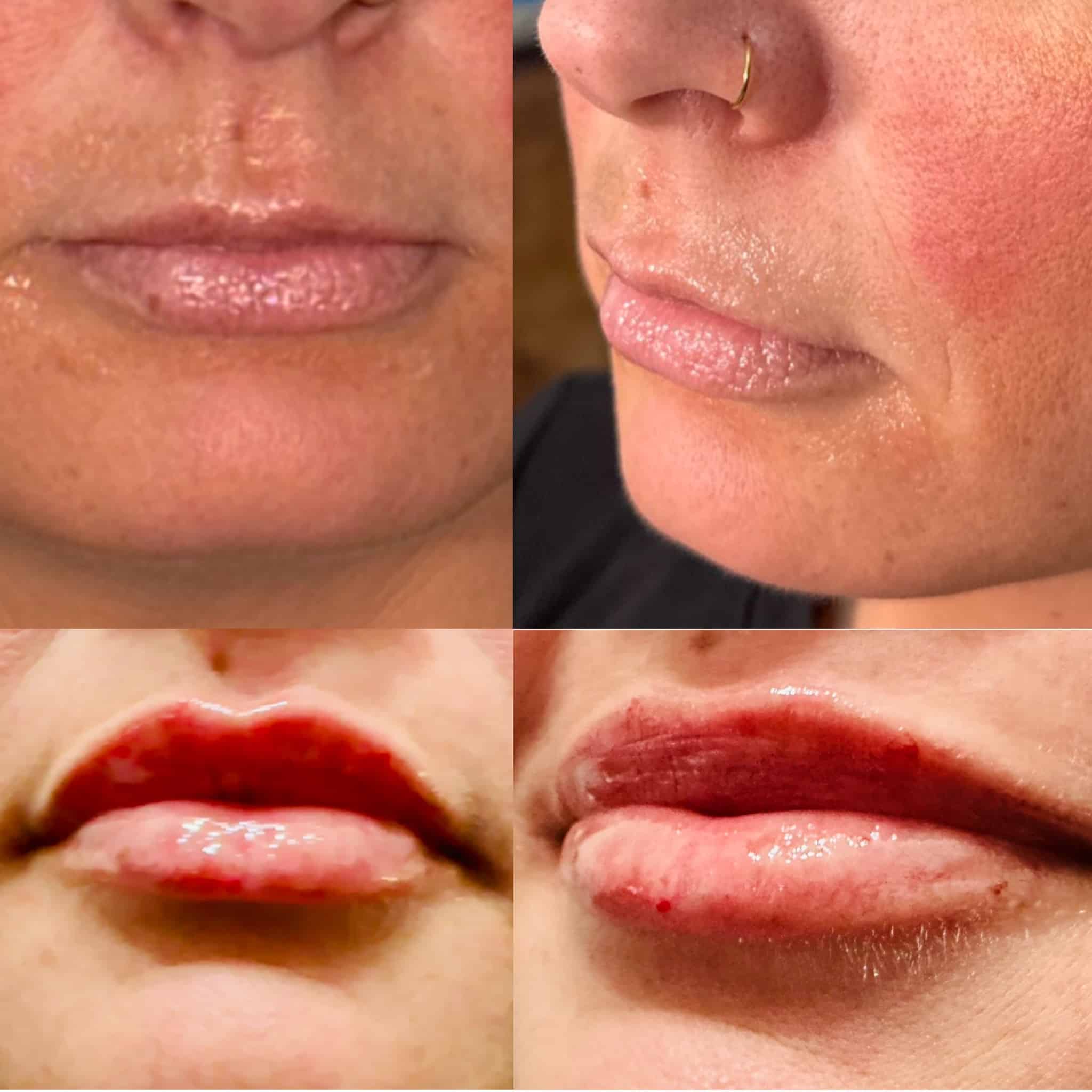 Before and After Image: Lip Filler - front