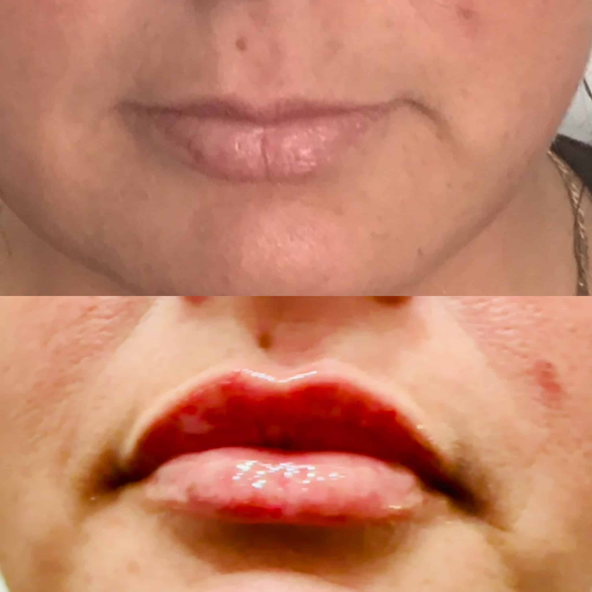 Before and After Image: Lip Filler - front