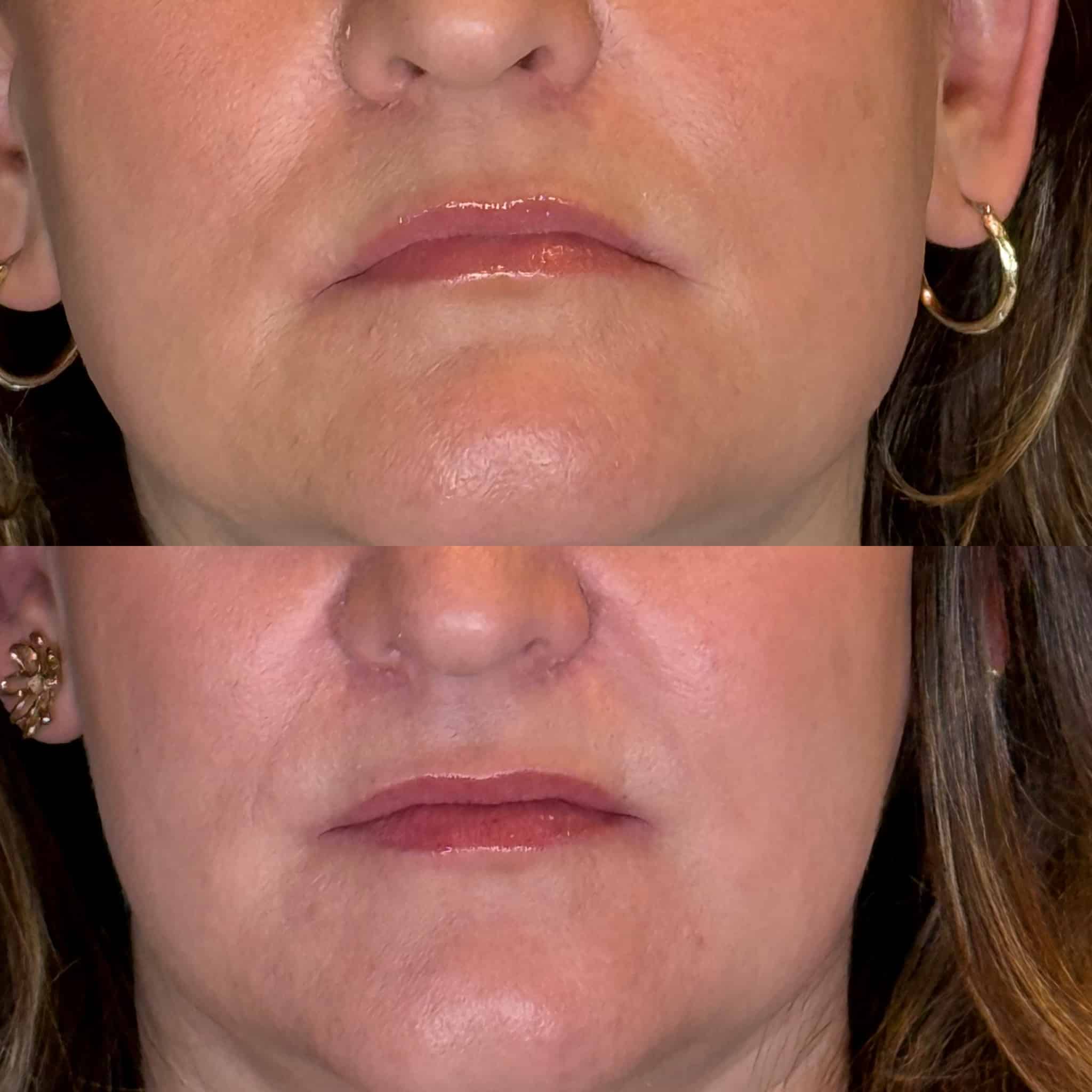 Before and After Image: Lip Filler - front