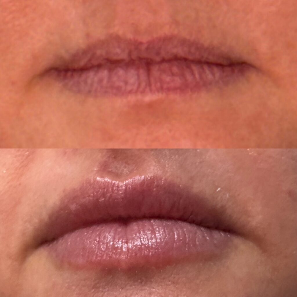 Before and After Image: Lip Filler - front