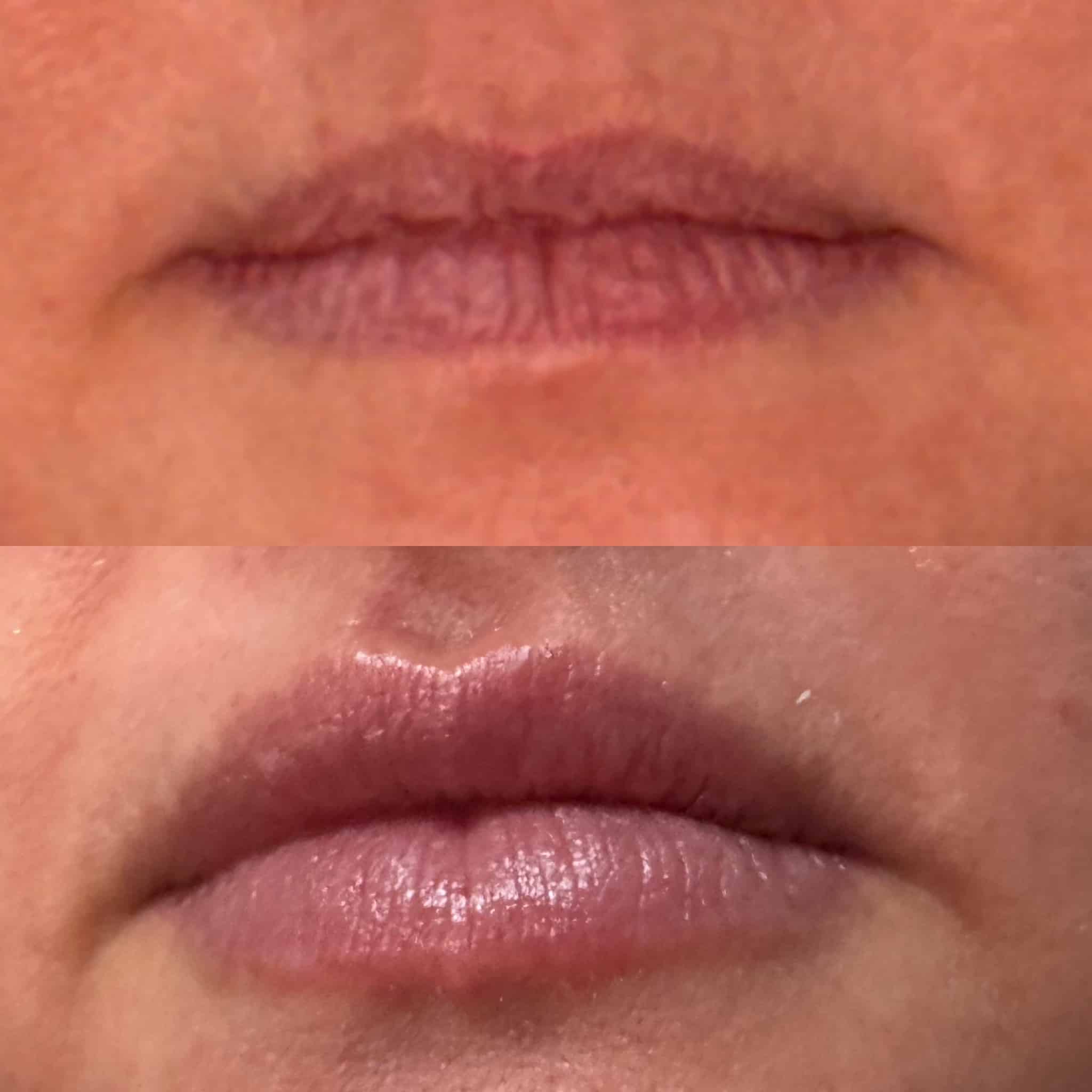Before and After Image: Lip Filler - front