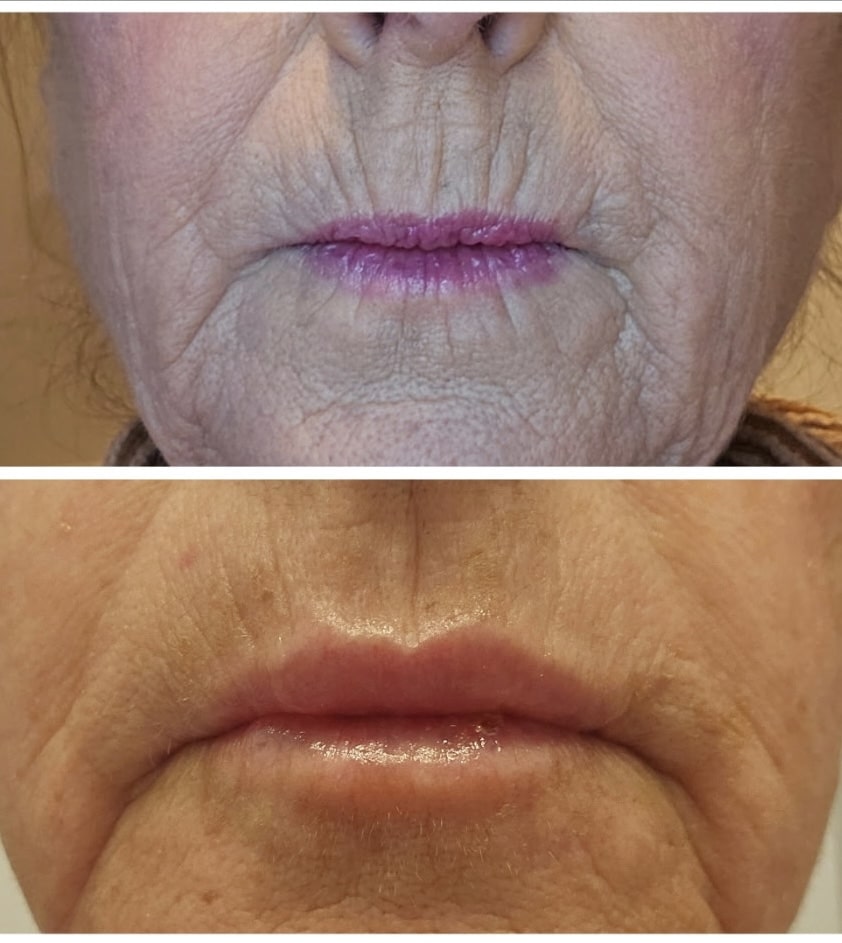 Before and After Image: Lip Filler - front