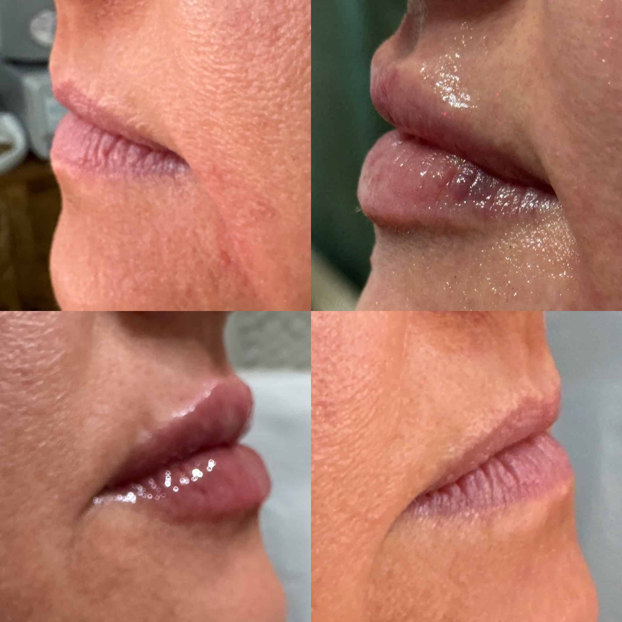 Before and After Image: Lip Filler - front