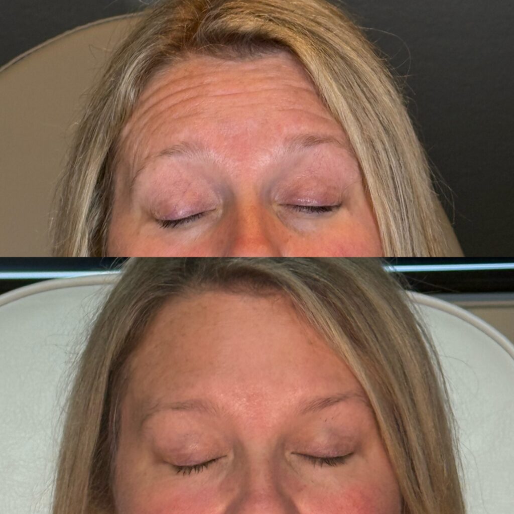 Before and After Image: Neurotoxin - front