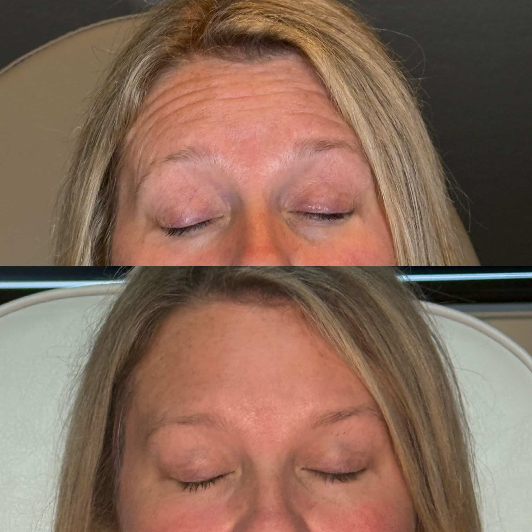 Before and After Image: Neurotoxin - front