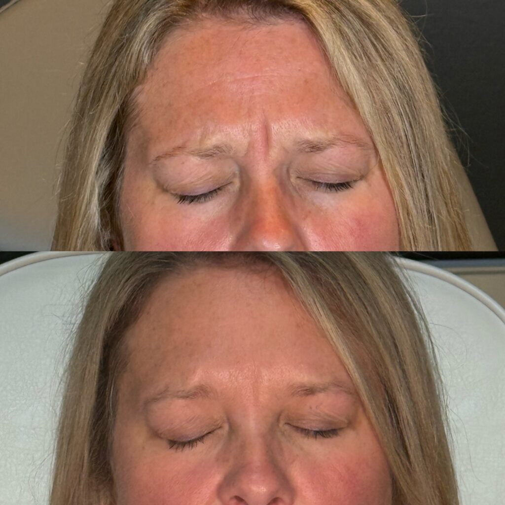 Before and After Image: Neurotoxin - front