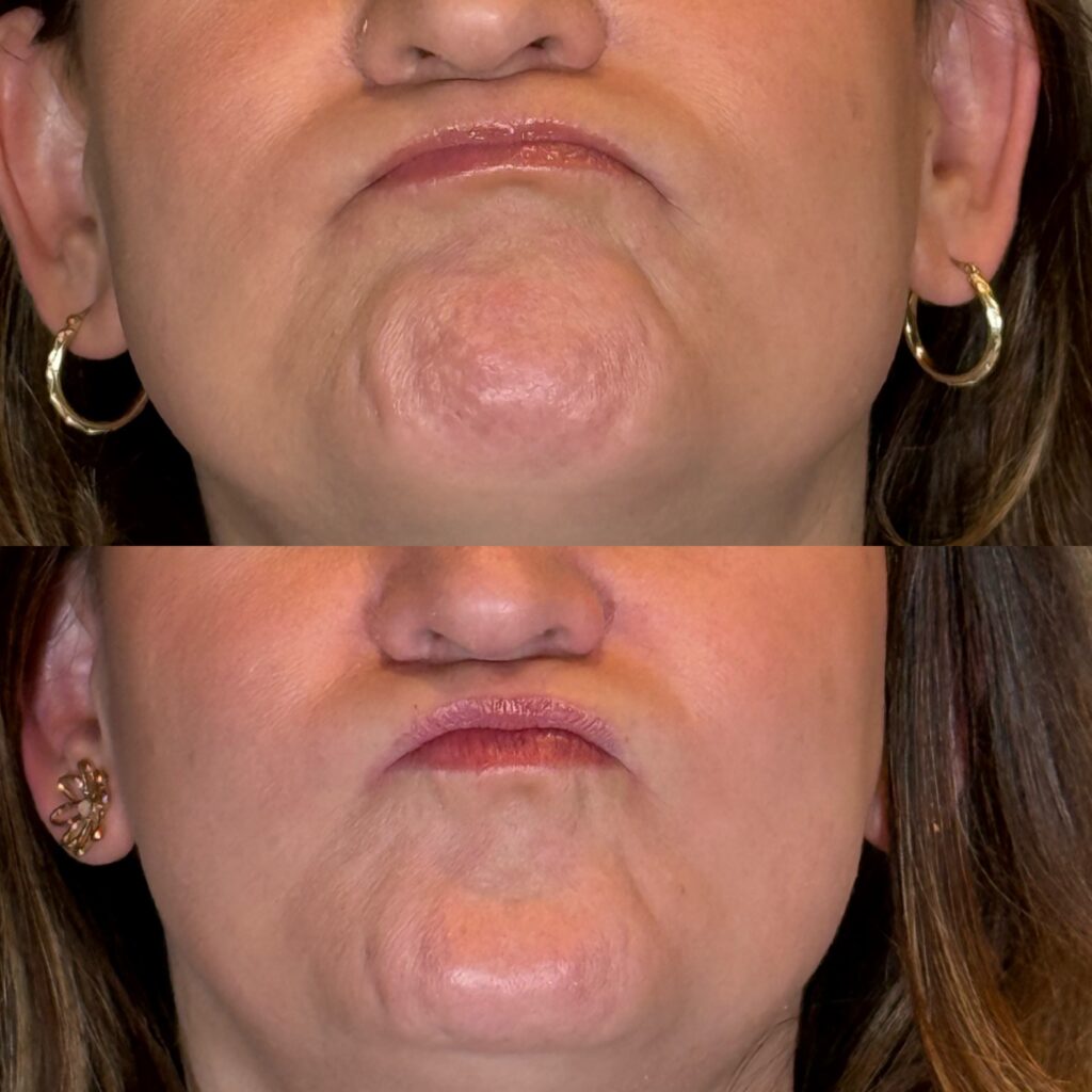 Before and After Image: Neurotoxin - front