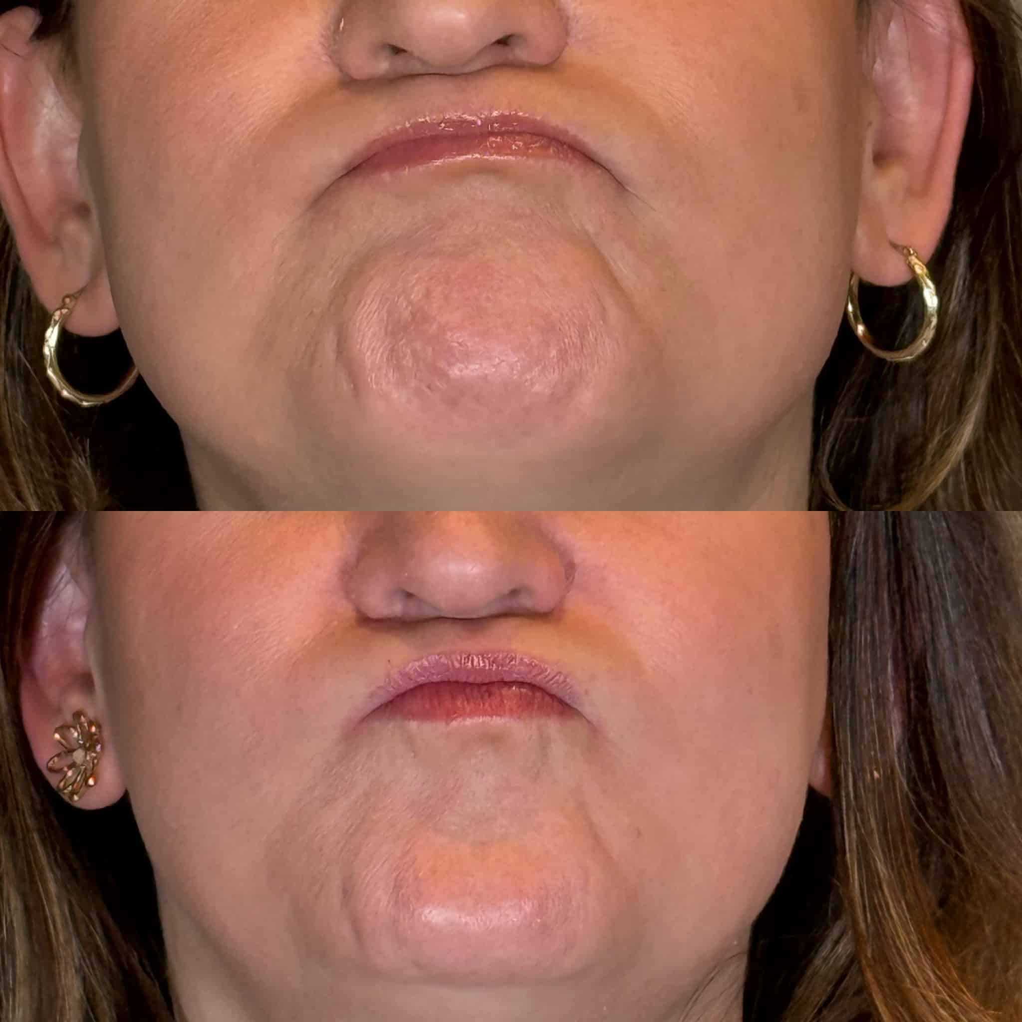 Before and After Image: Neurotoxin - front