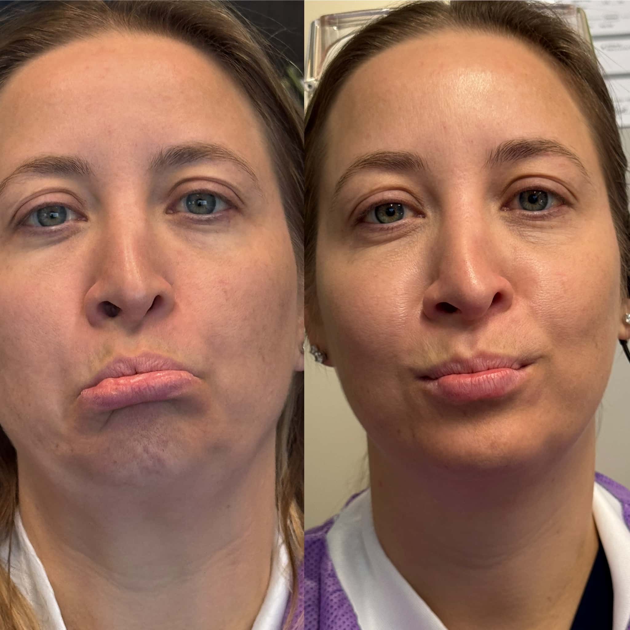 Before and After Image: Neurotoxin - front