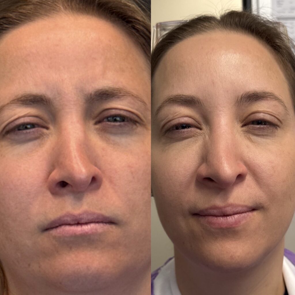 Before and After Image: Neurotoxin - front