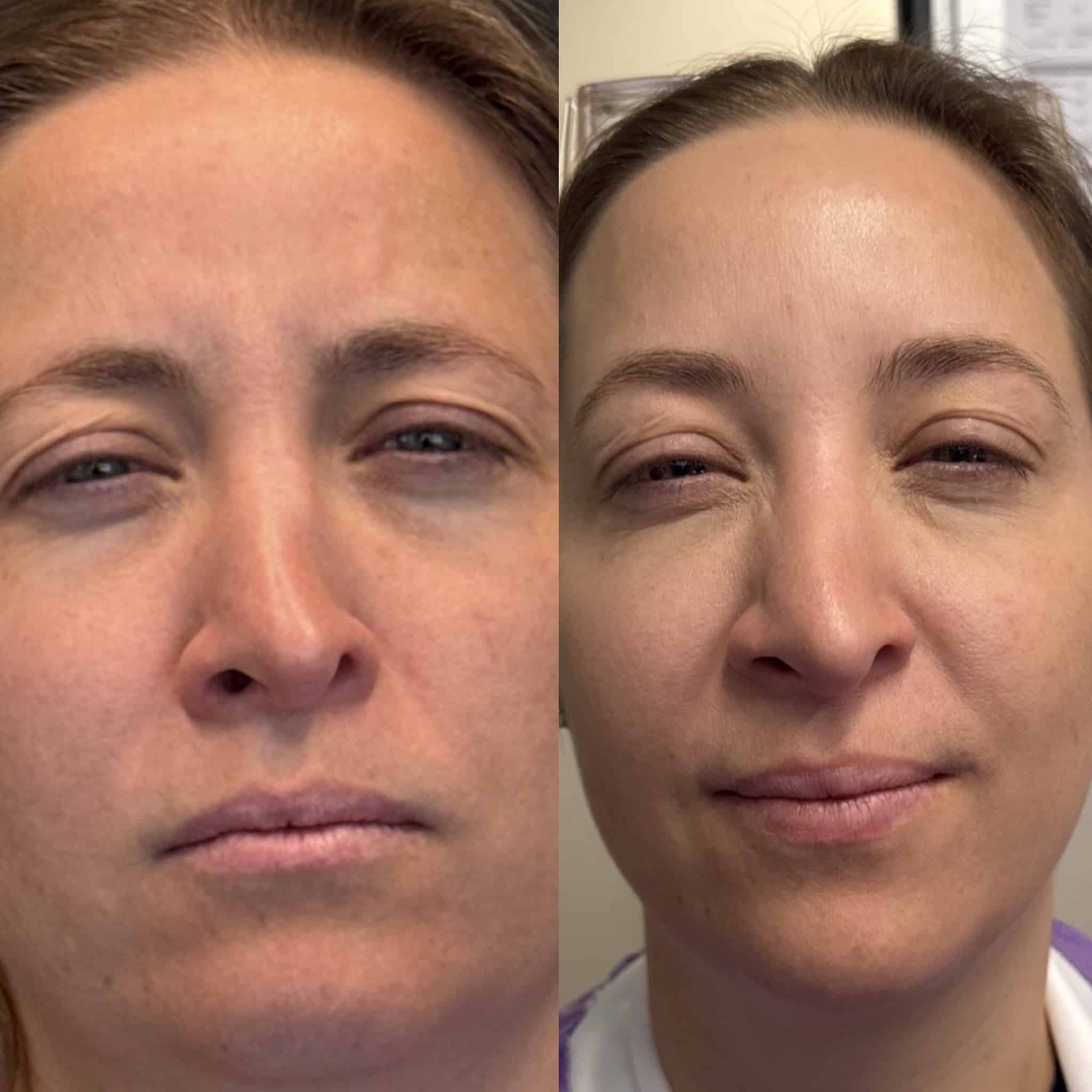 Before and After Image: Neurotoxin - front