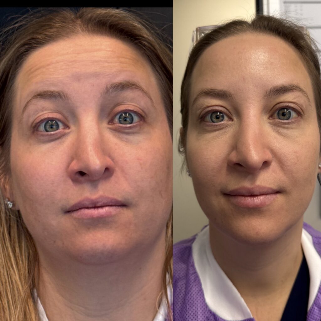 Before and After Image: Neurotoxin - front