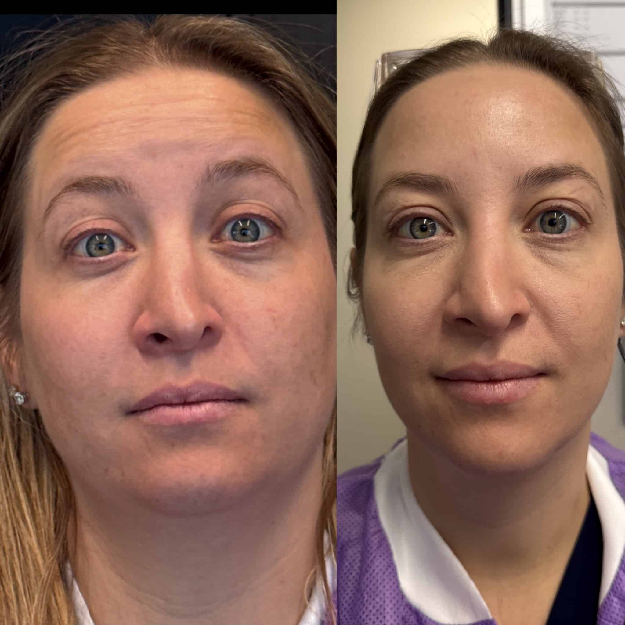 Before and After Image: Neurotoxin - front