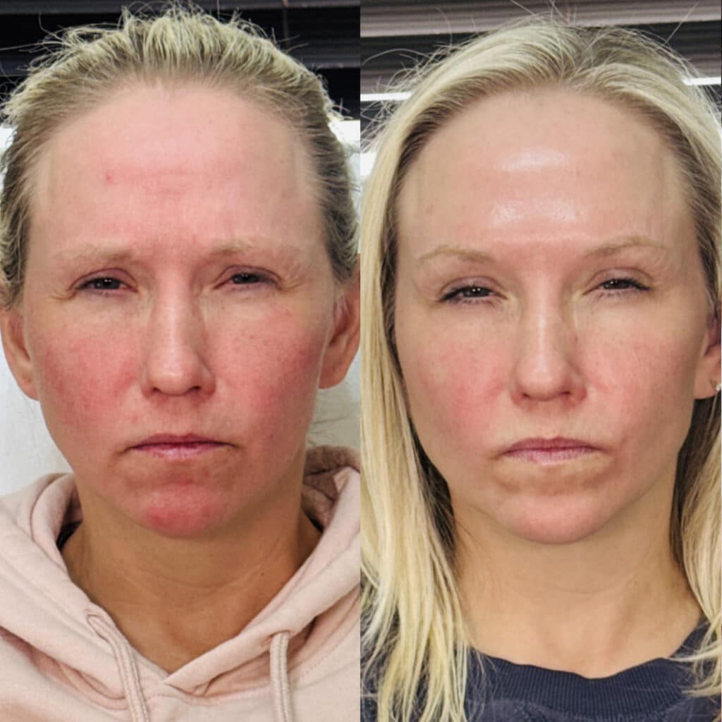 Before and After Image: Neurotoxin - front