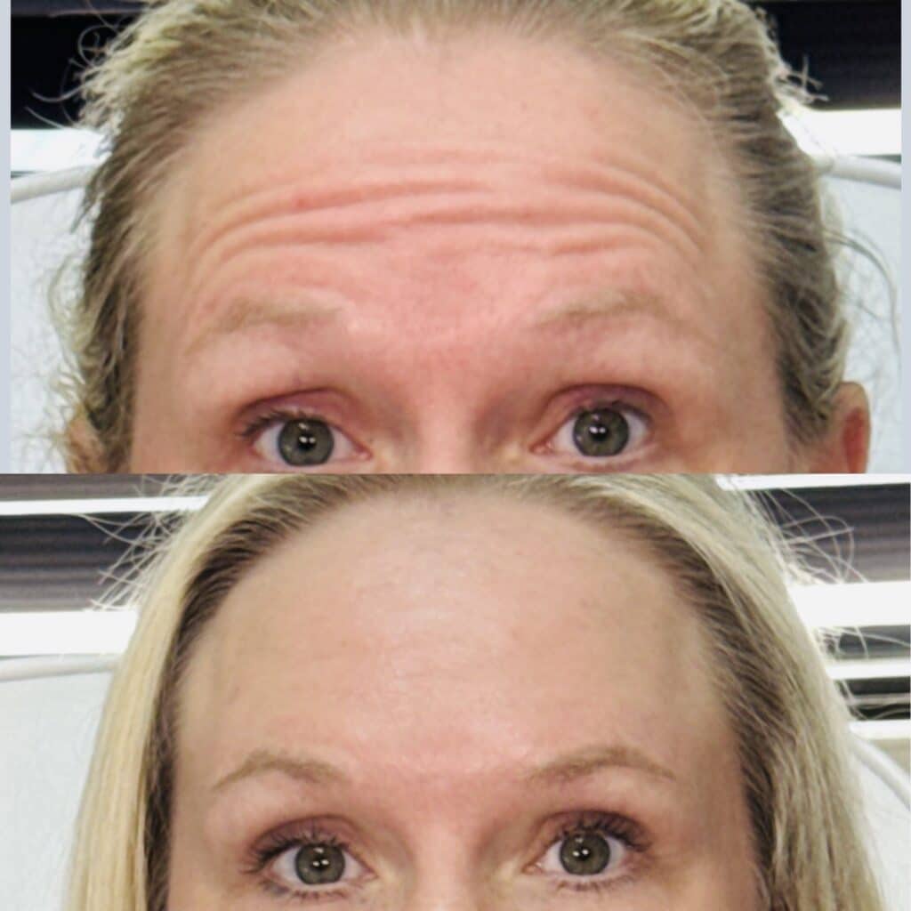 Before and After Image: Neurotoxin - front