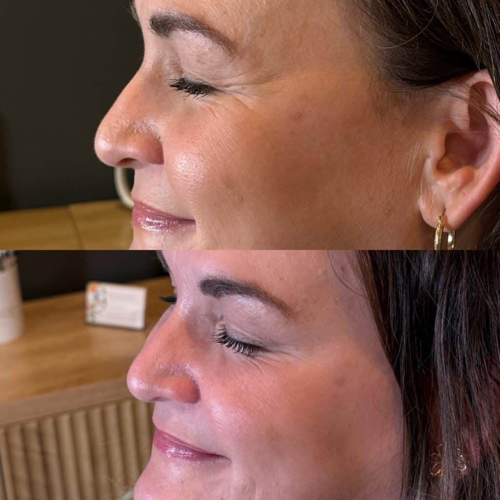 Before and After Image: Neurotoxin - left-front-oblique