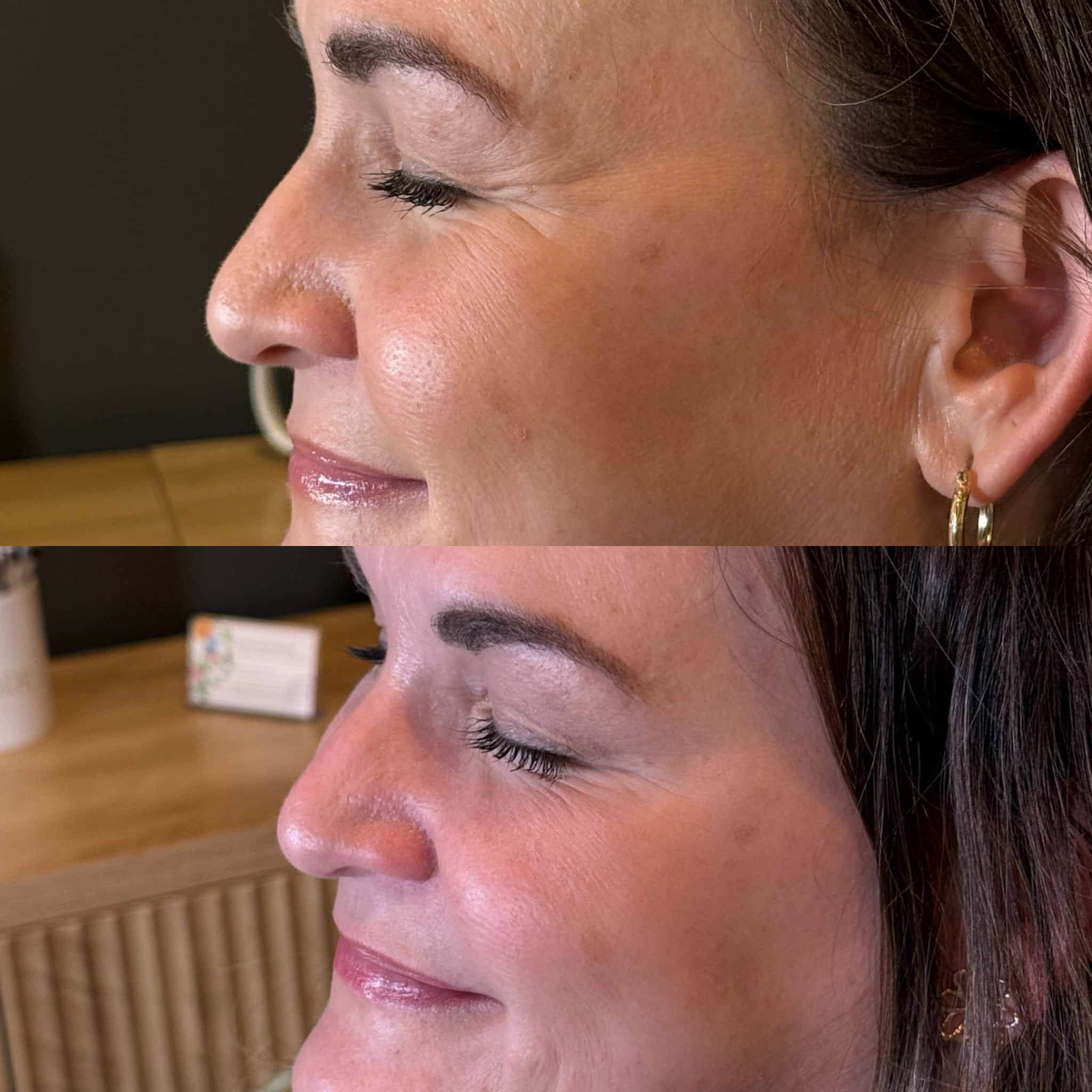 Before and After Image: Neurotoxin - left-front-oblique